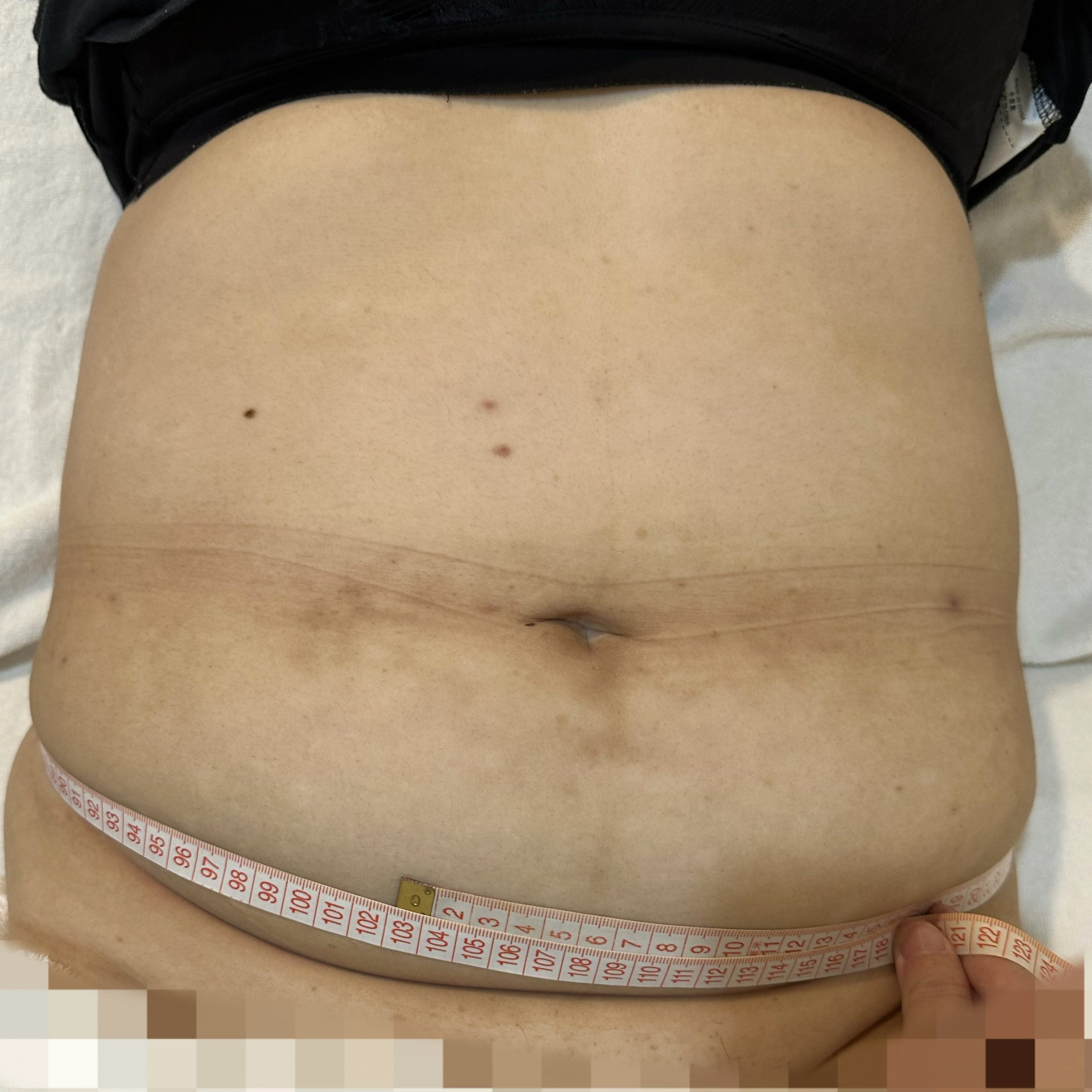 Client stomach before Coolshaping2 fat freezing.