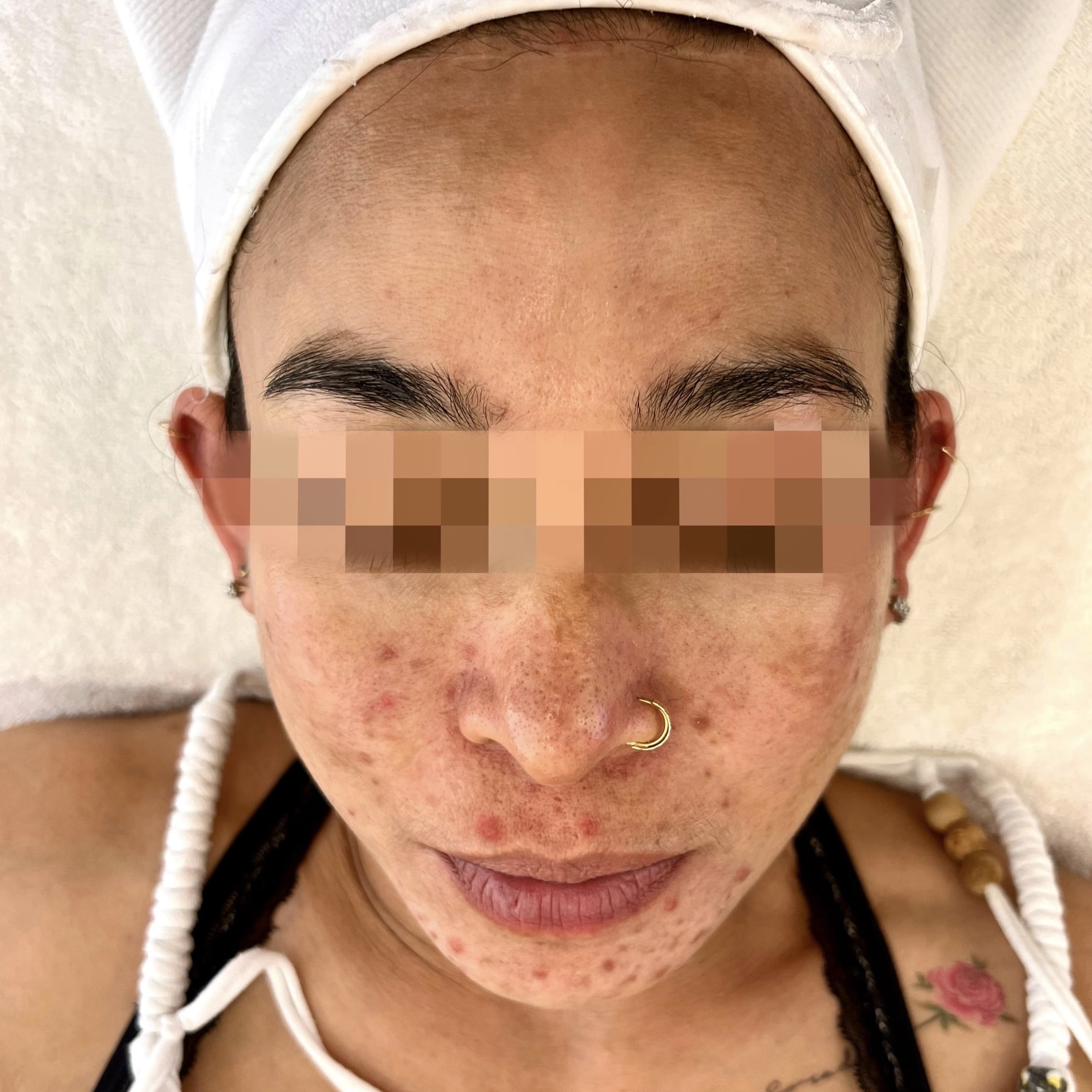 Client before Dermashine Meostherapy Acne Banish Injection