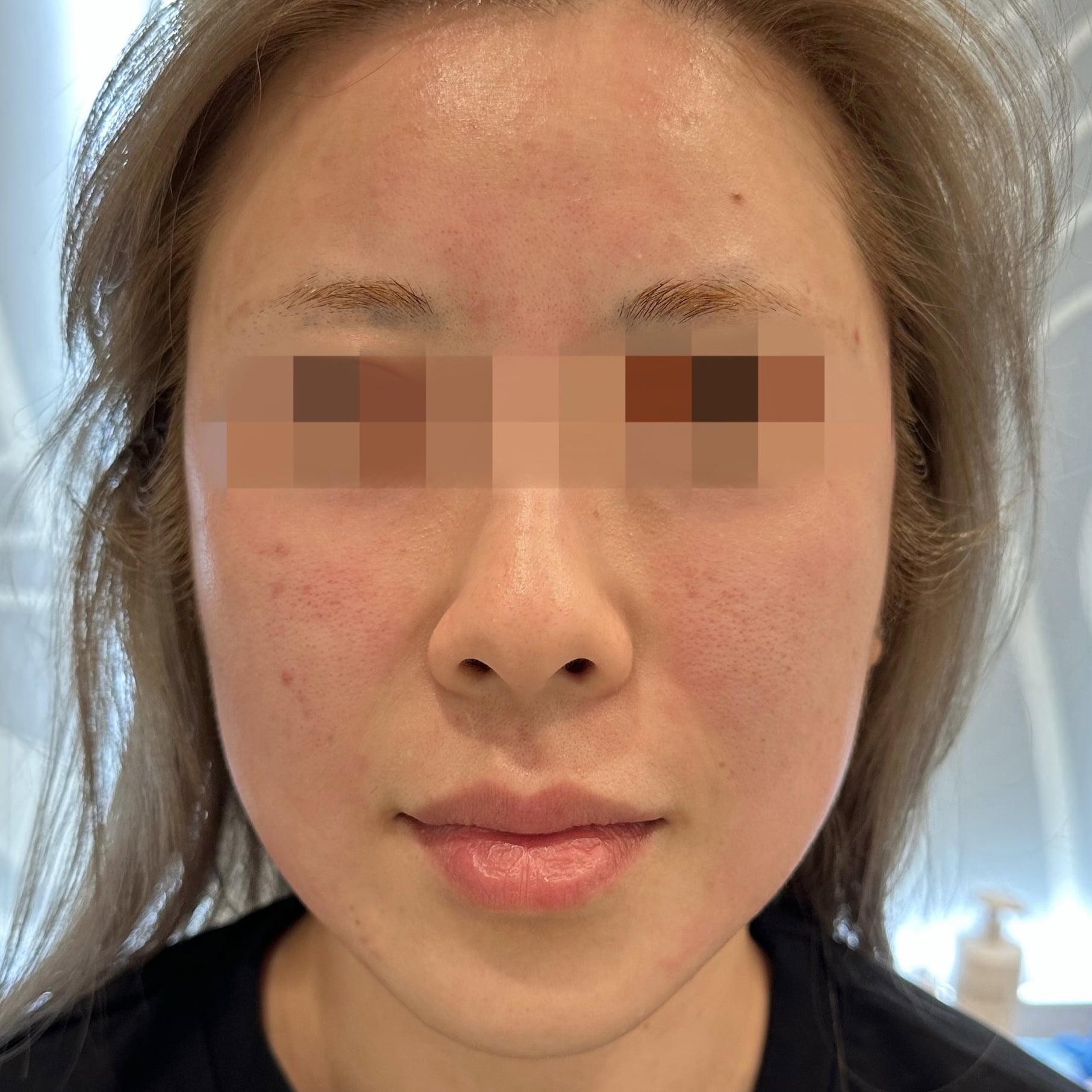 Client after Ultraformer III treatment, with tightened and lifted face and skin.