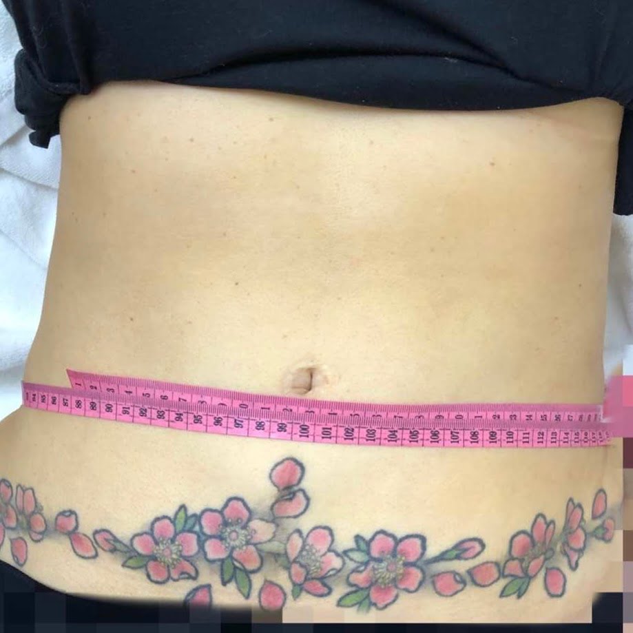Client stomach before Coolshaping2 fat freezing.