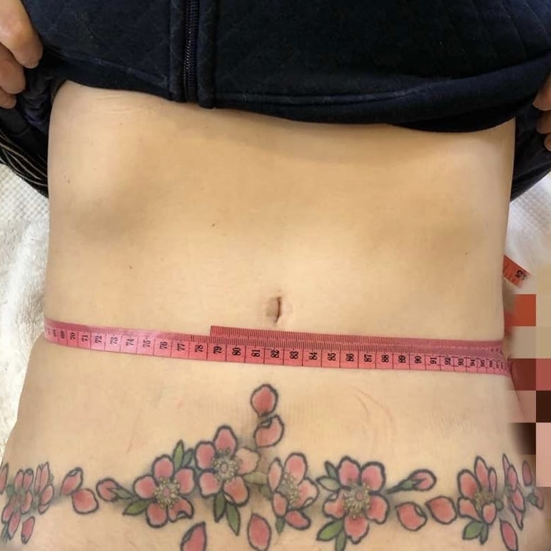 Clients stomach after 1 session Coolshaping2 fat freezing.