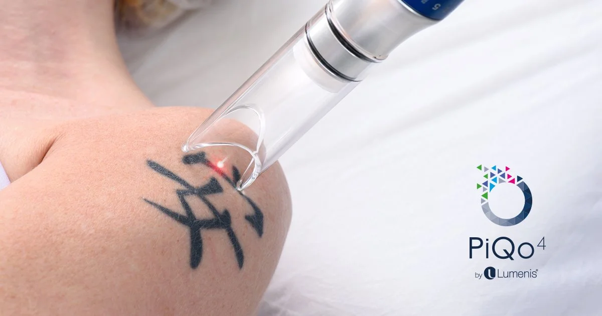 Laser Tattoo Removal - Perfect SMP