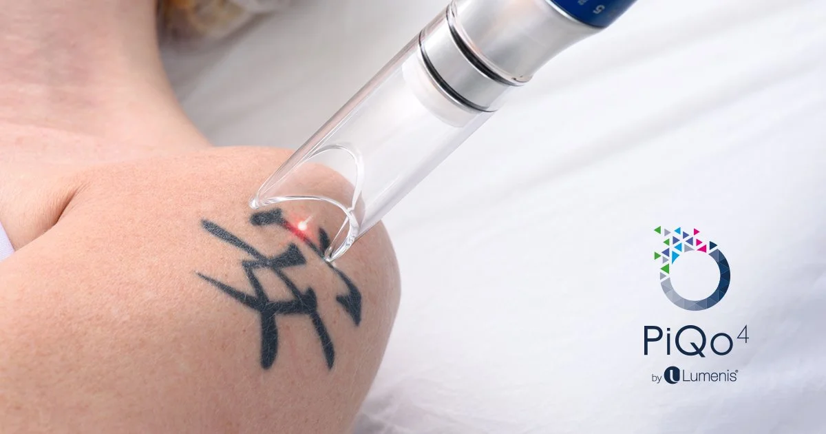 The Science Behind Tattoo Removal