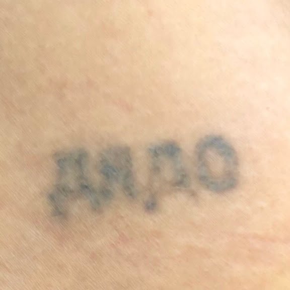 Client after 1 session of PiQo4 tattoo removal laser