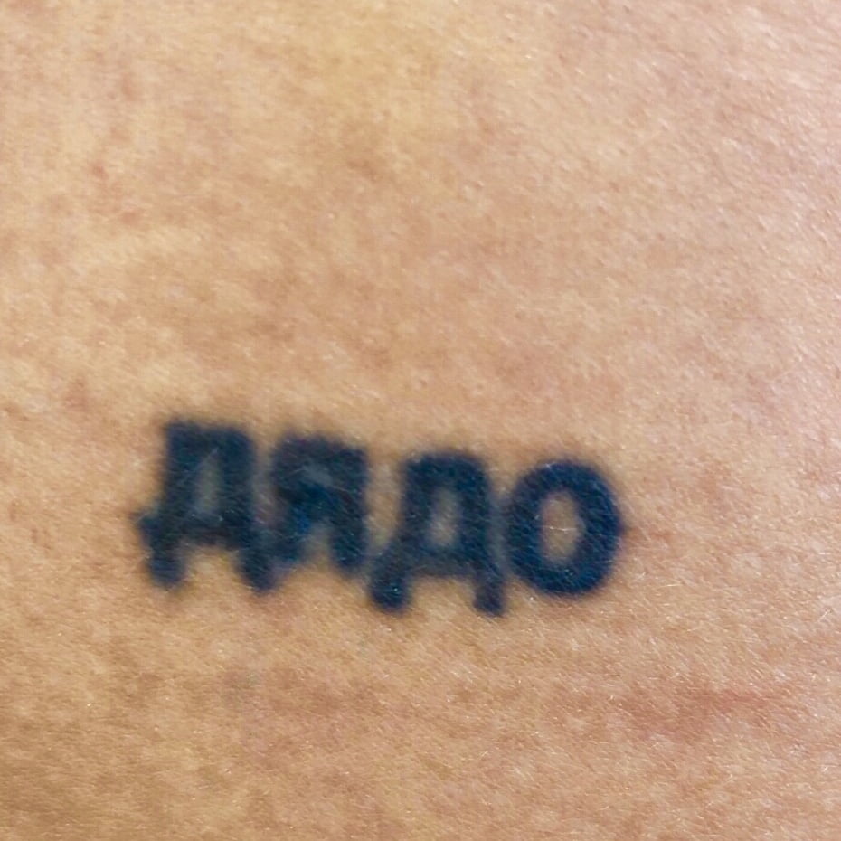 Client Before PiQo4 tattoo removal laser