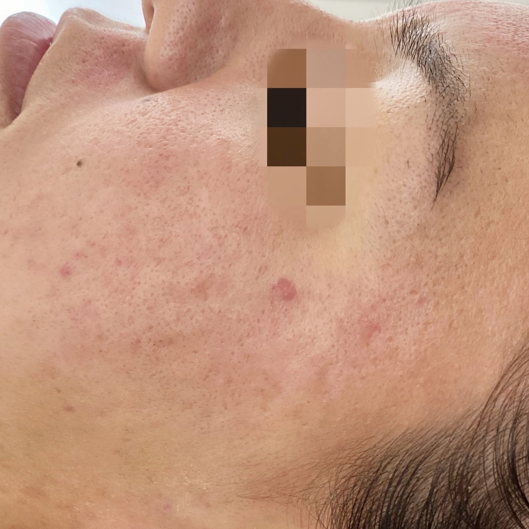 Client after 3 sessions of Venus Viva acne scar resurfacing.