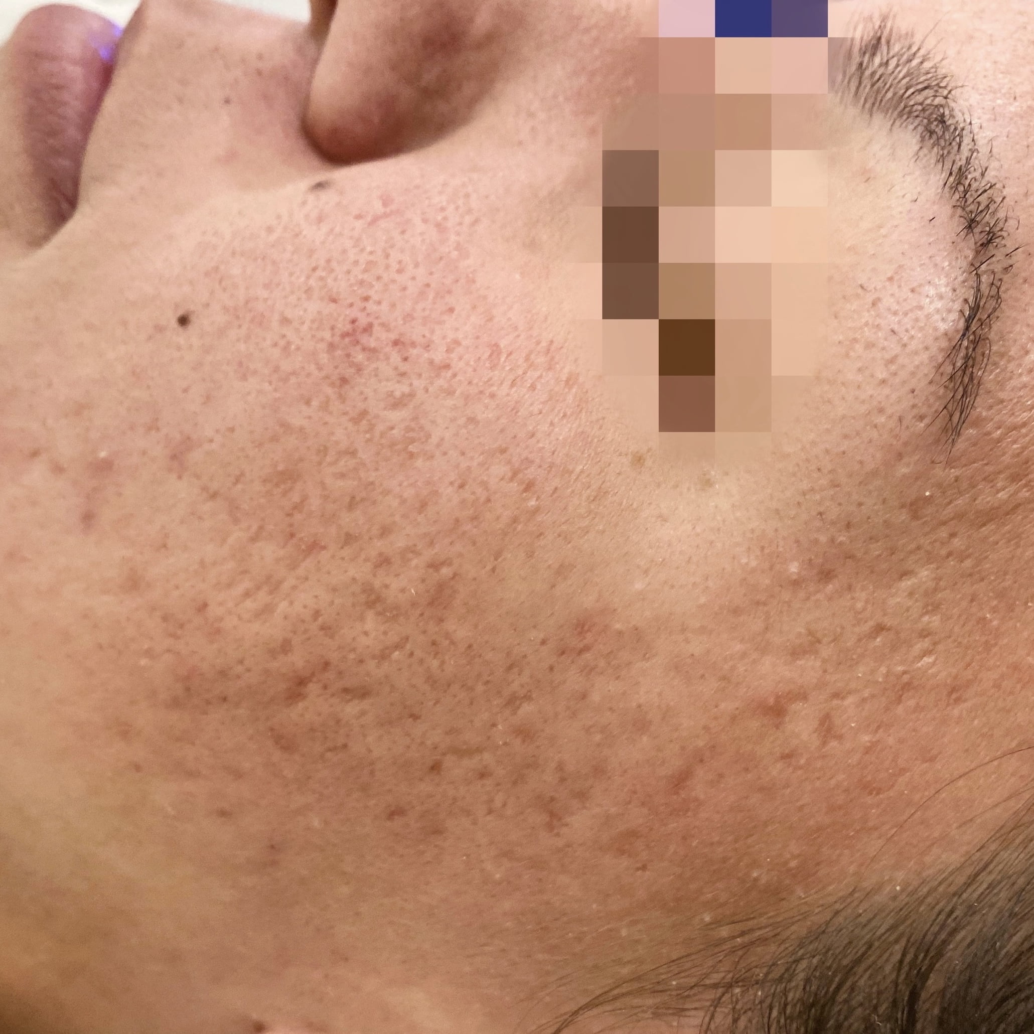 Client before Venus Viva acne scar resurfacing.