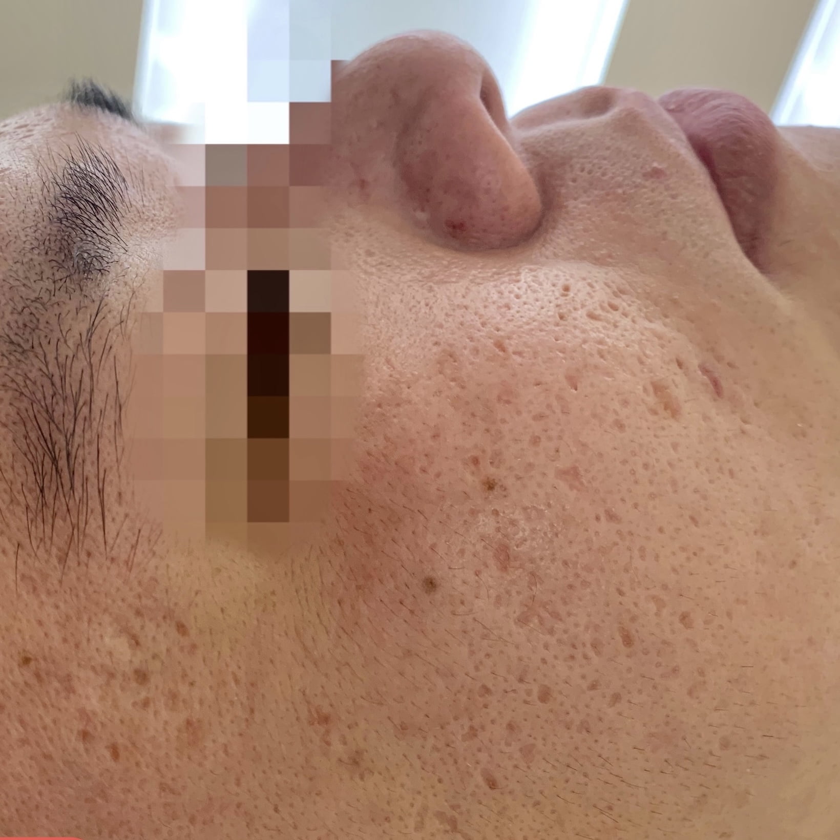 Client before Venus Viva acne scar resurfacing.