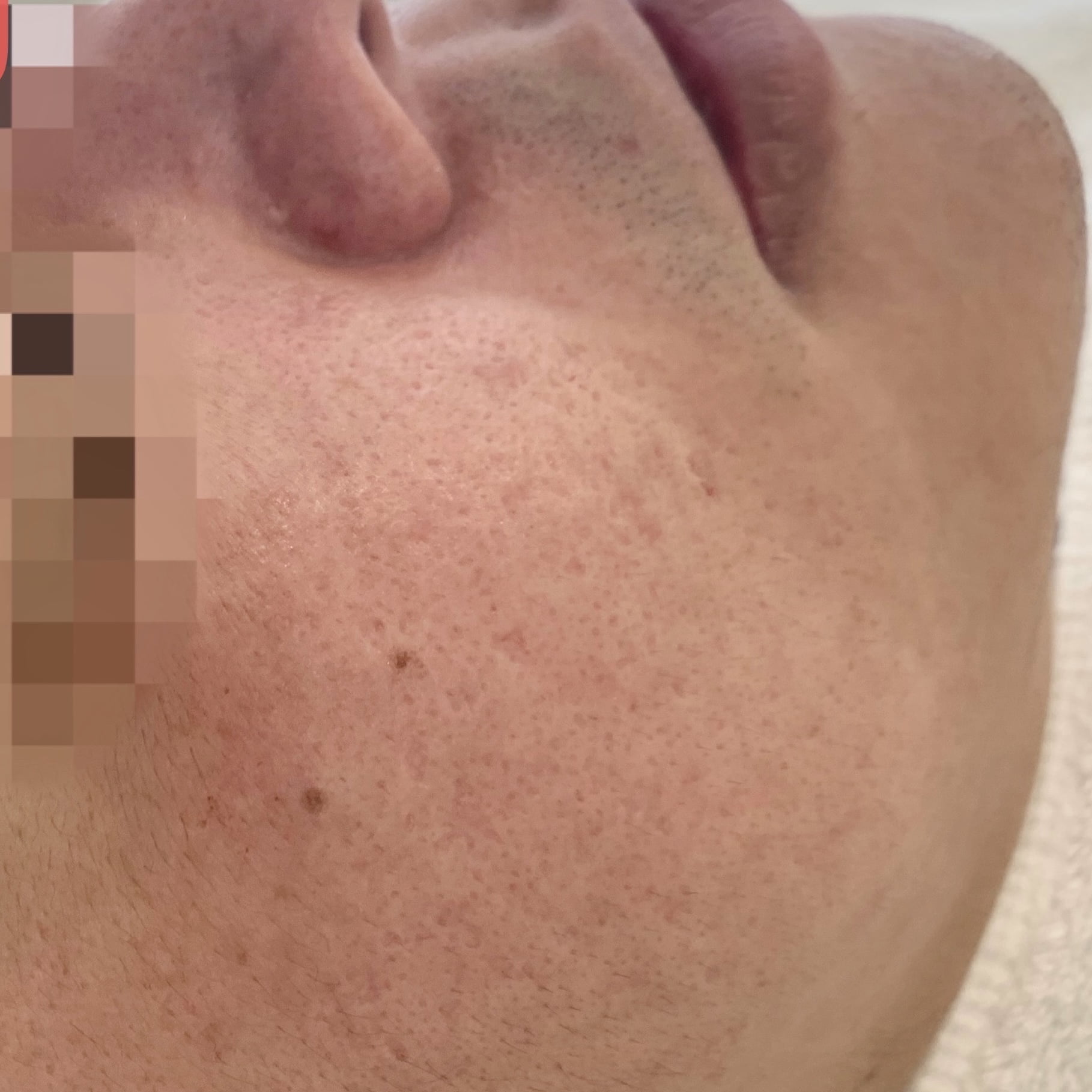 Client after 2 sessions of Venus Viva acne scar resurfacing.