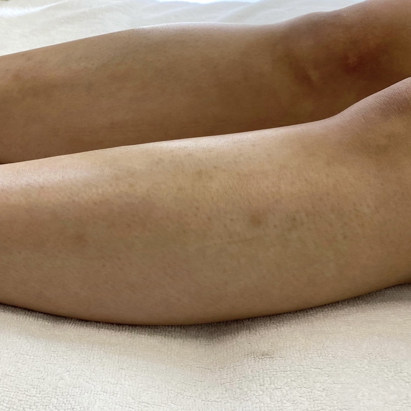 After 2 sessions of PiQo4 leg body Laser