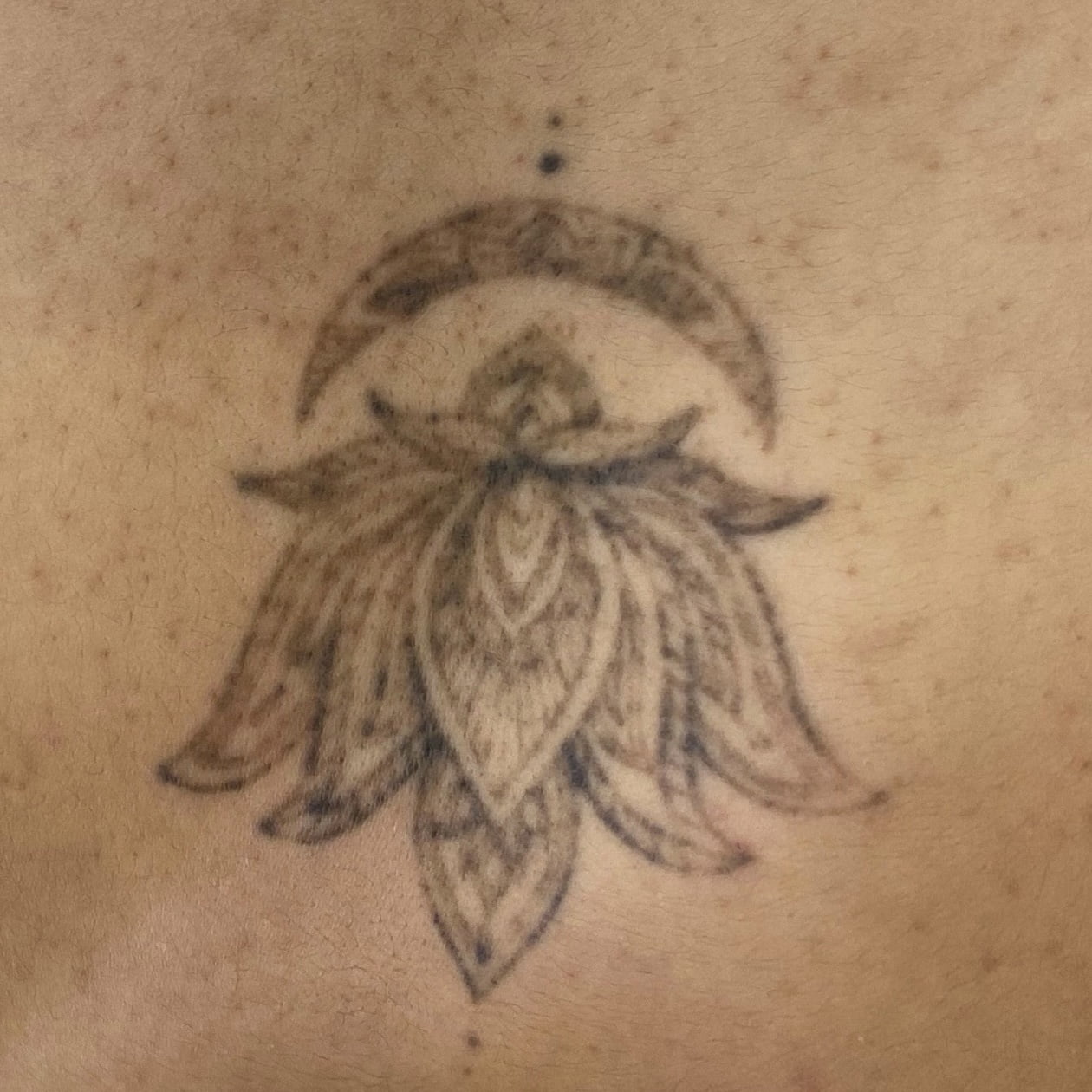 Client after 1 session of PiQo4 tattoo removal laser