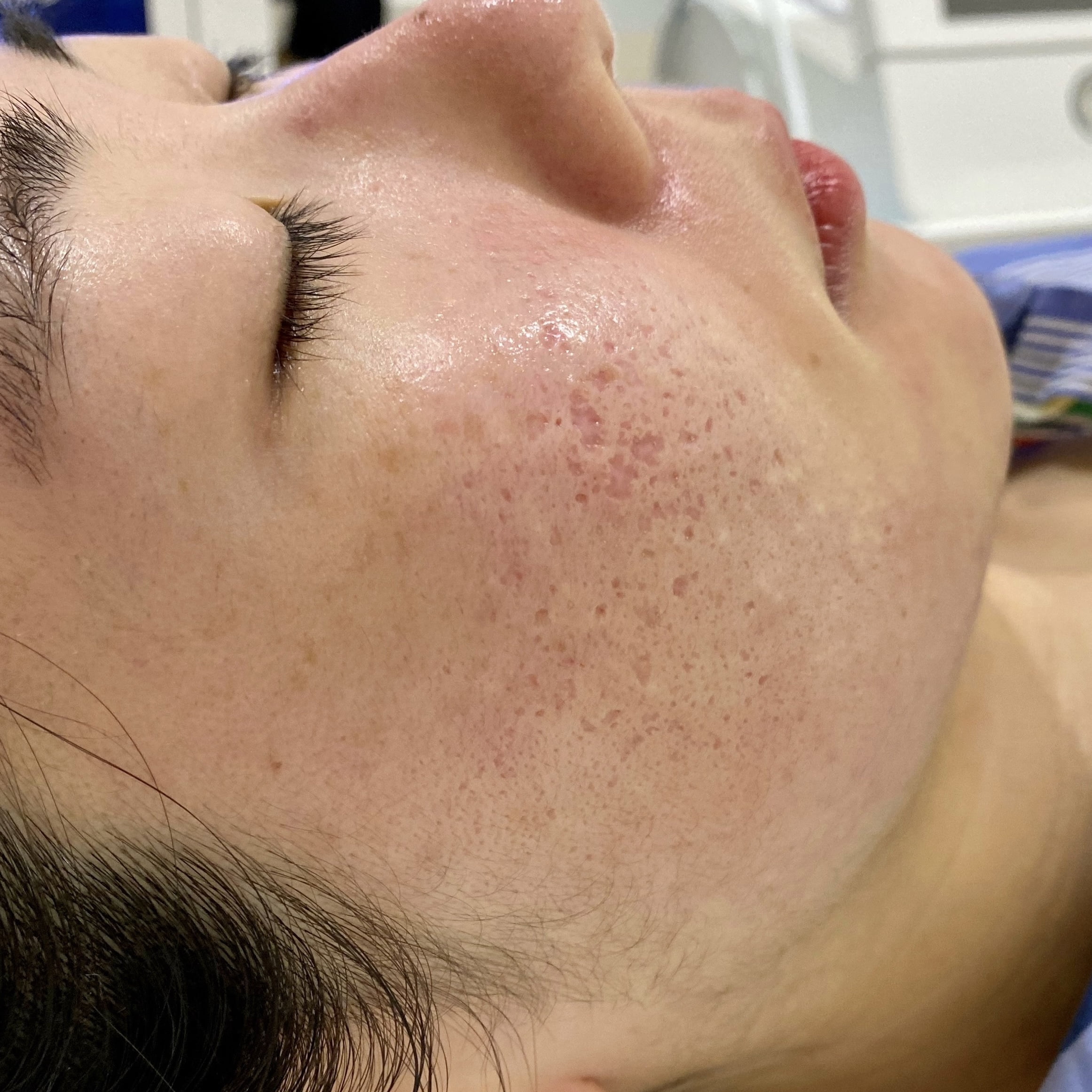 Client before Venus Viva acne scar resurfacing.