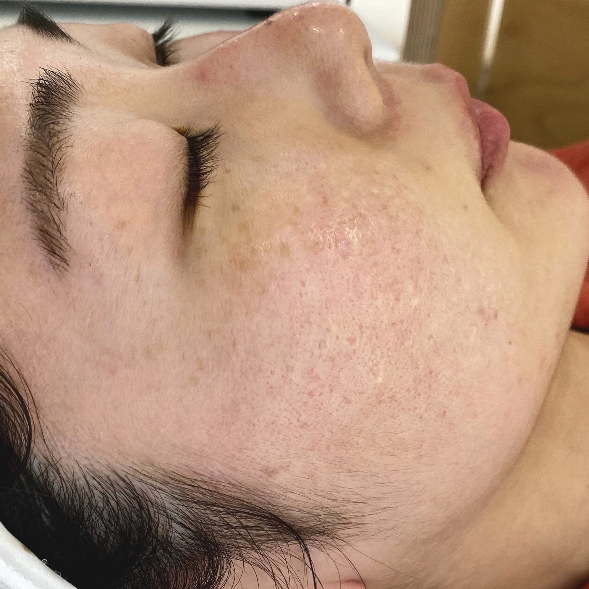 Client after 2 sessions of Venus Viva acne scar resurfacing.