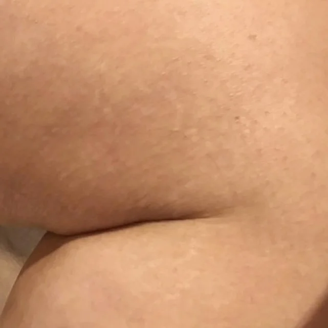 Client after 1 session of Venus Viva stretch mark resurfacing