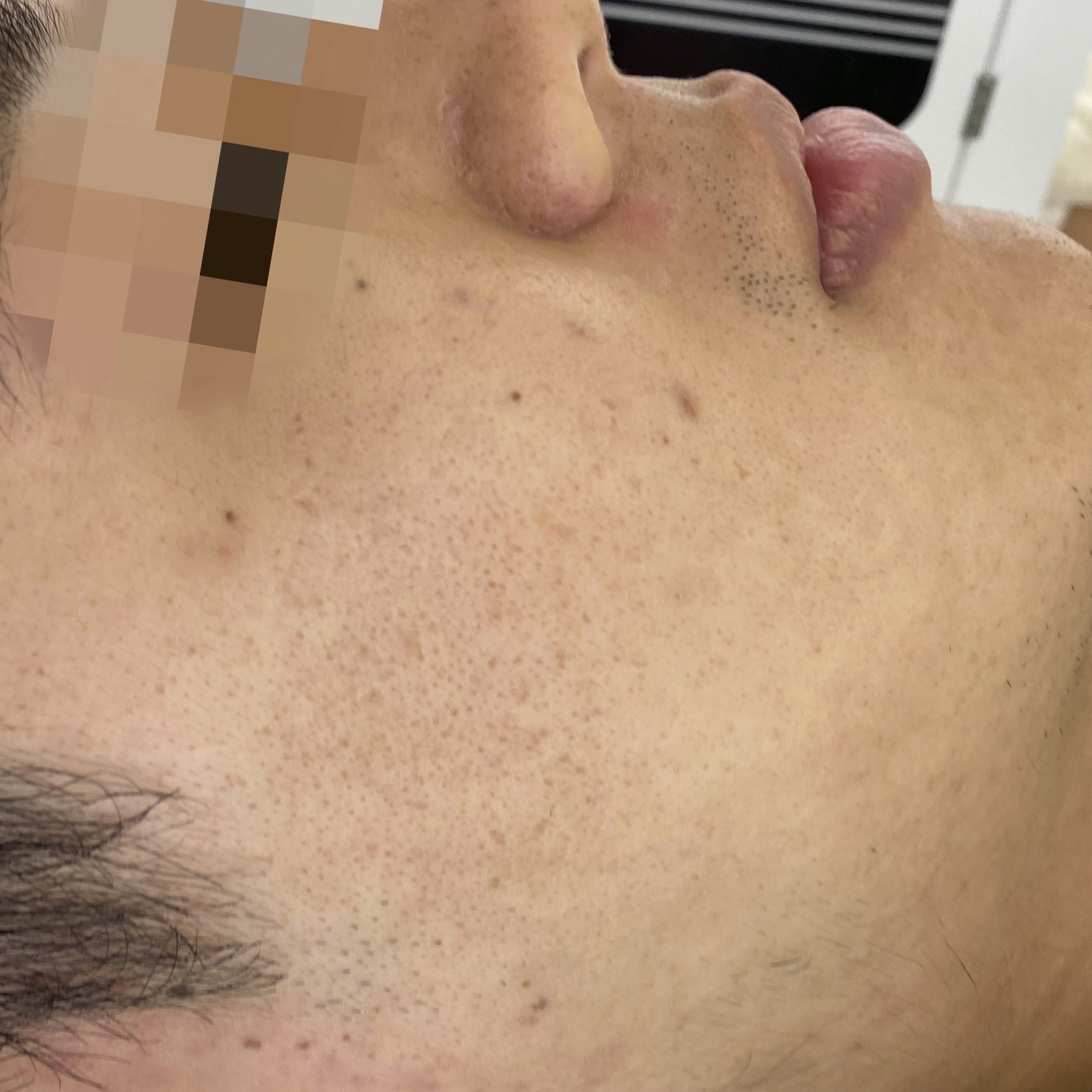 Client after 3 sessions of Venus Viva acne scar resurfacing.