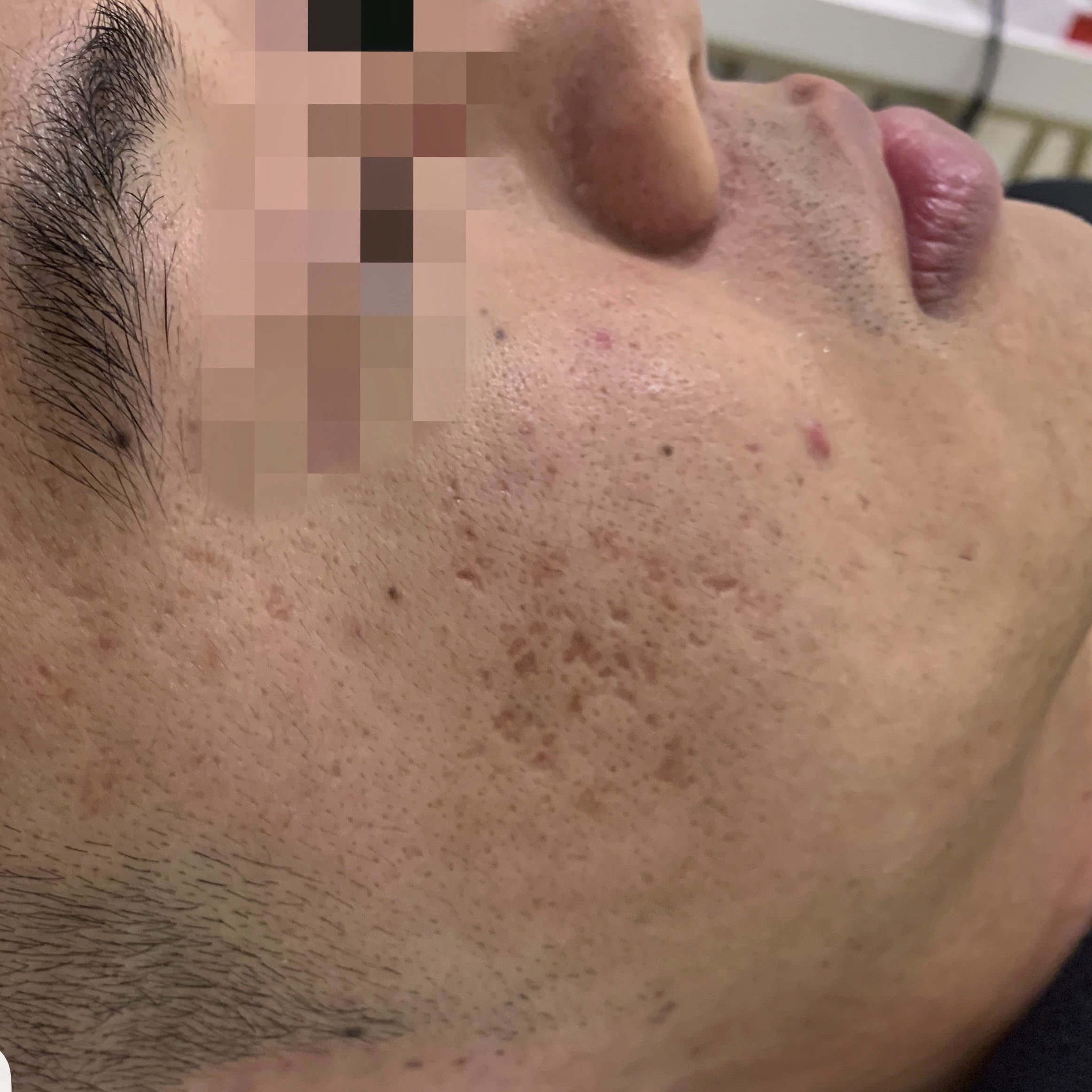 Client before Venus Viva acne scar resurfacing.