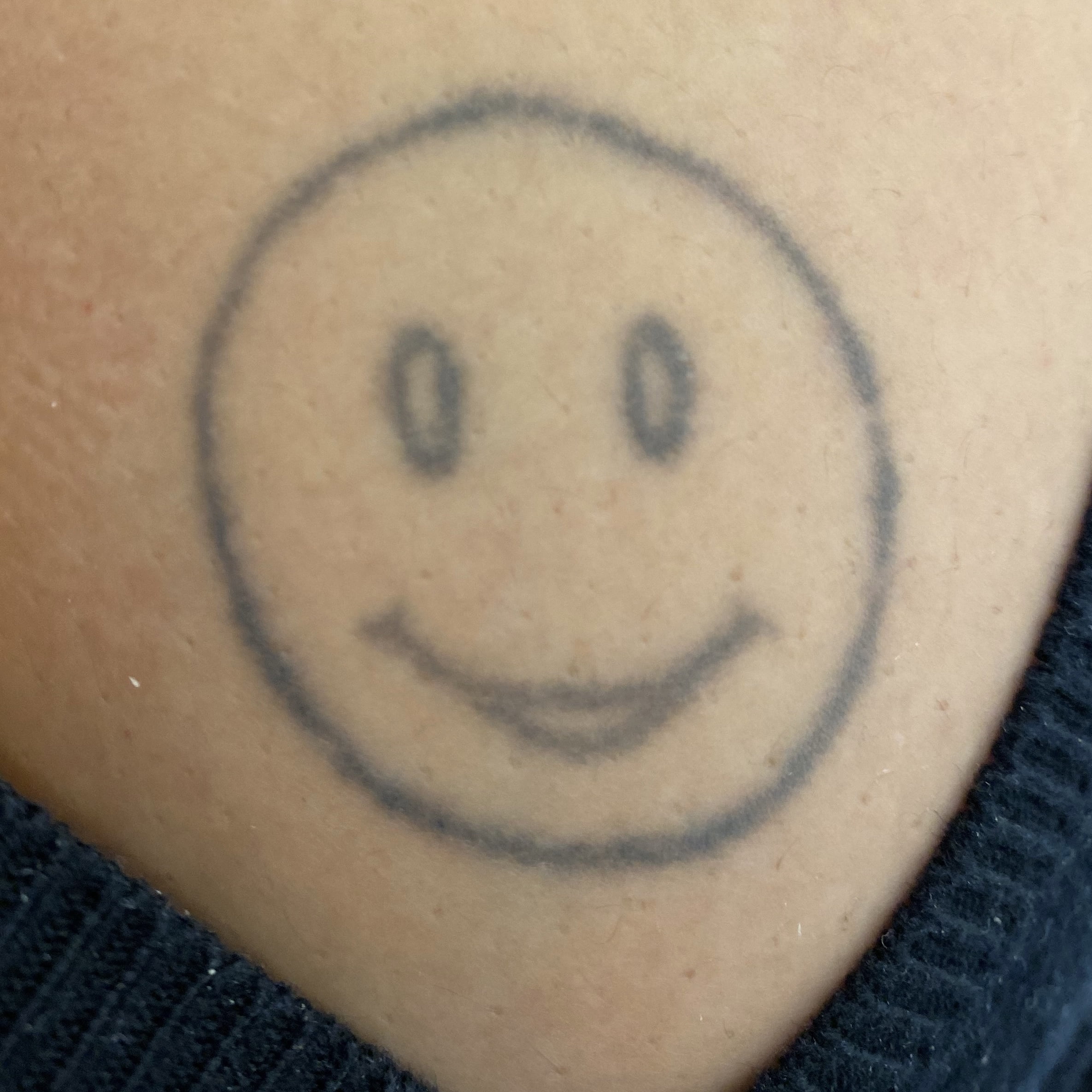 Client Before PiQo4 tattoo removal laser