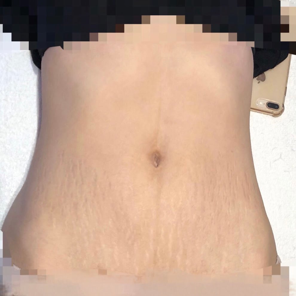 Client after 1 session of Venus Viva stretch mark resurfacing