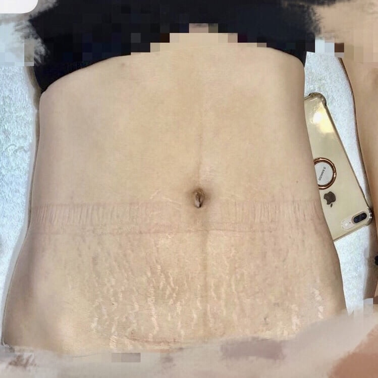 Client Before 1 session of Venus Viva stretch mark resurfacing