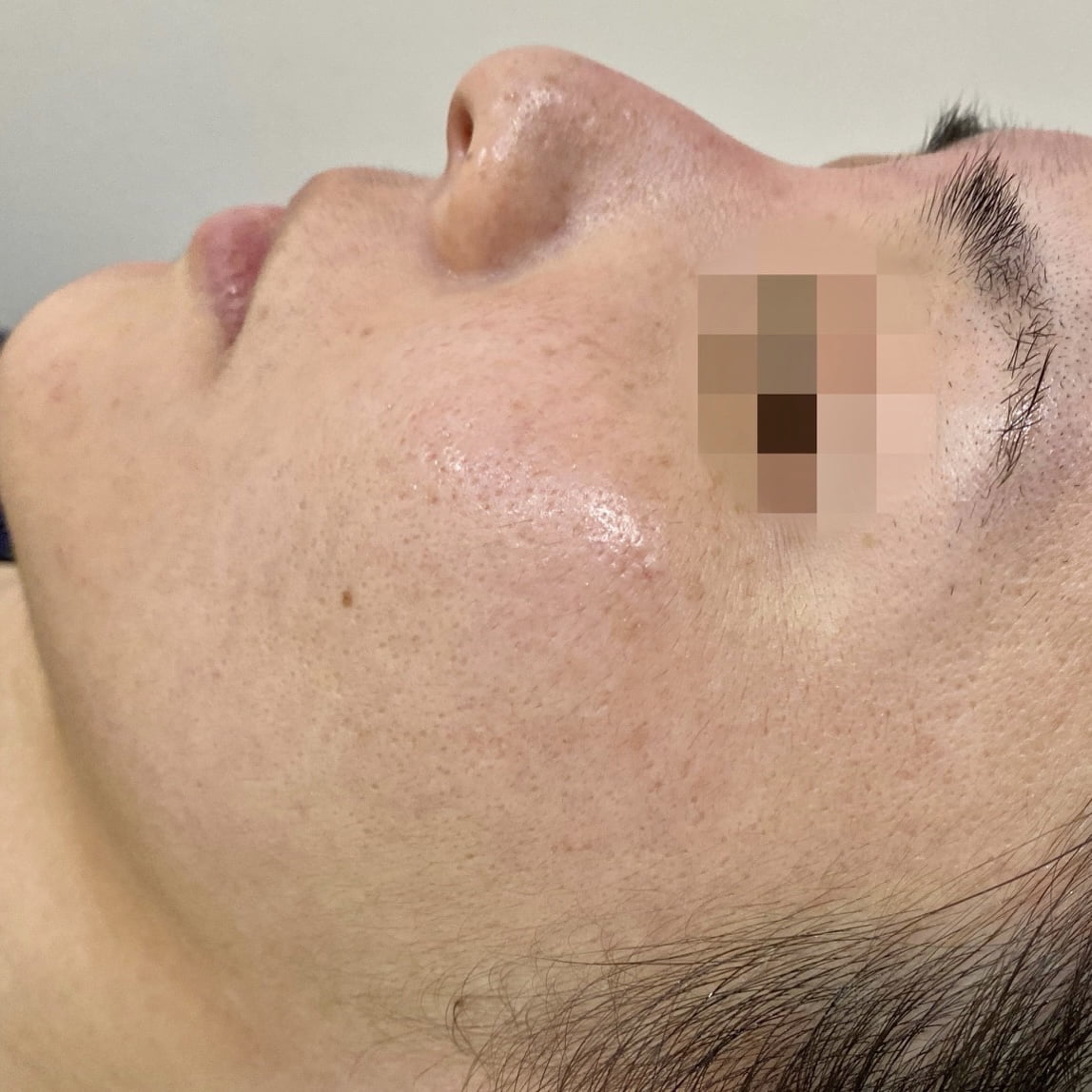 Client after 3 sessions of Venus Viva acne scar resurfacing.