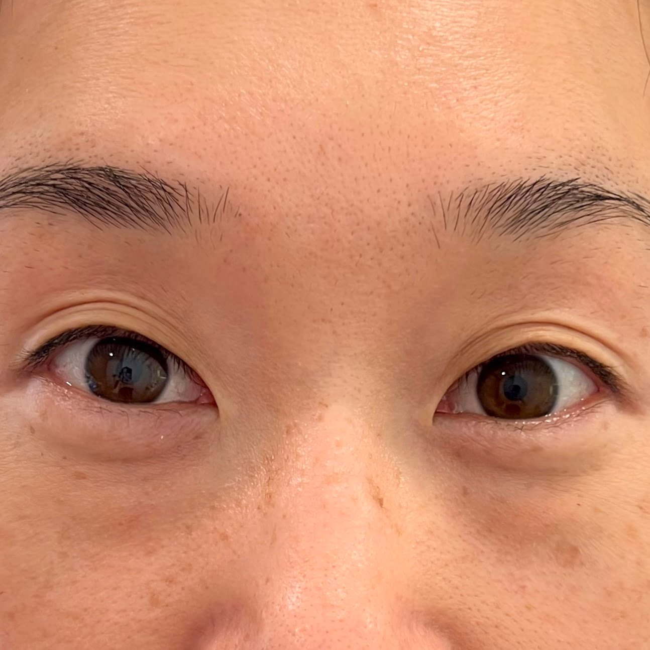 Client before Thermage Barbie Eye treatment