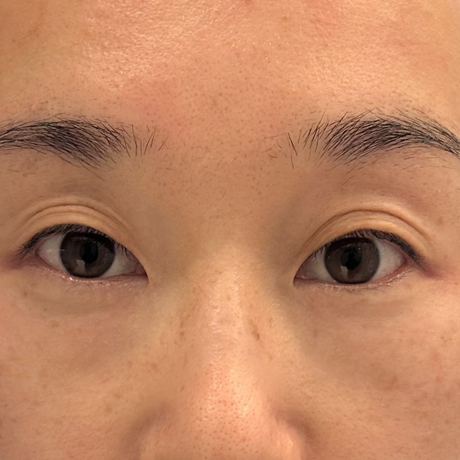 Client results instantly after 1 session Thermage Barbie Eye treatment
