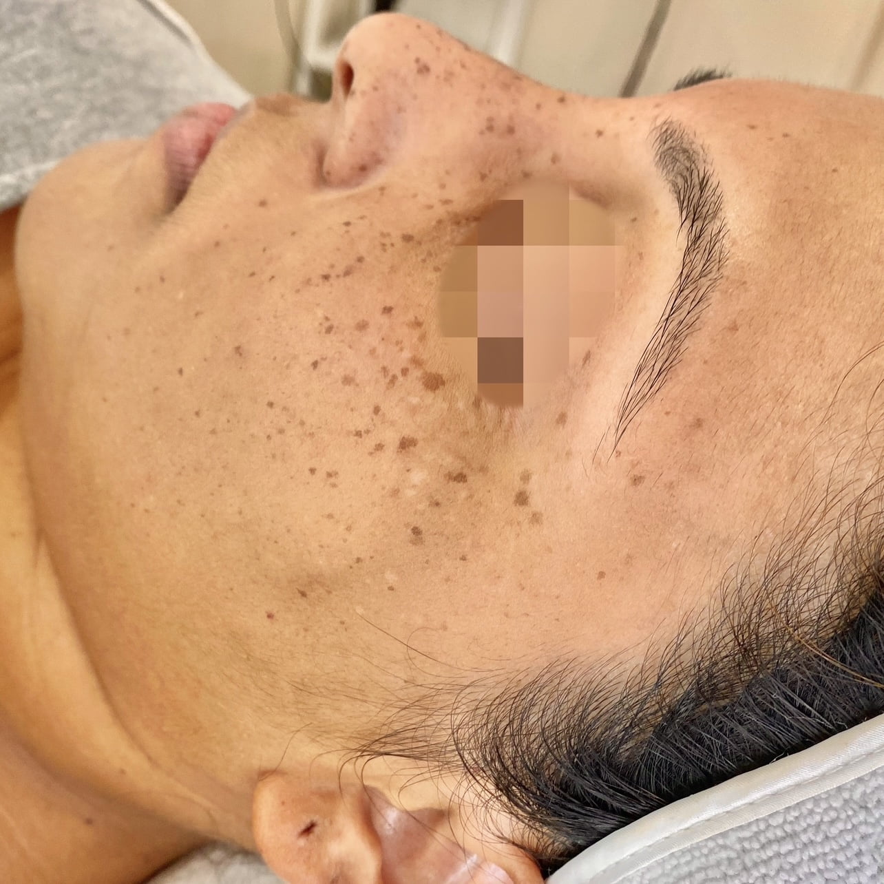 Client before PiQo4 Laser for face pigmentation.