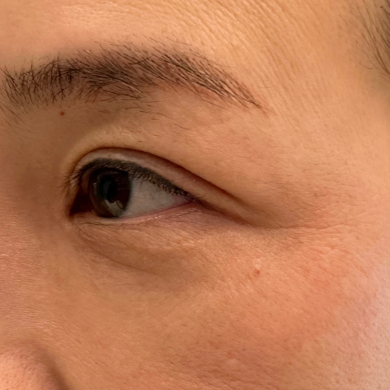 Client before Thermage Barbie Eye treatment