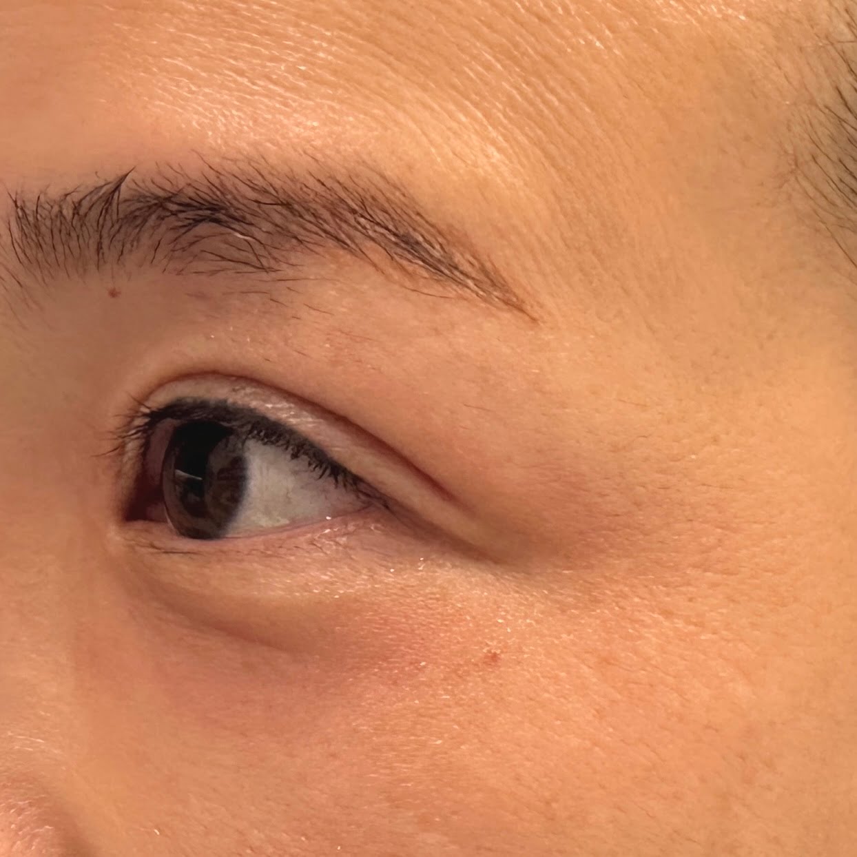 Client results instantly after 1 session Thermage Barbie Eye treatment