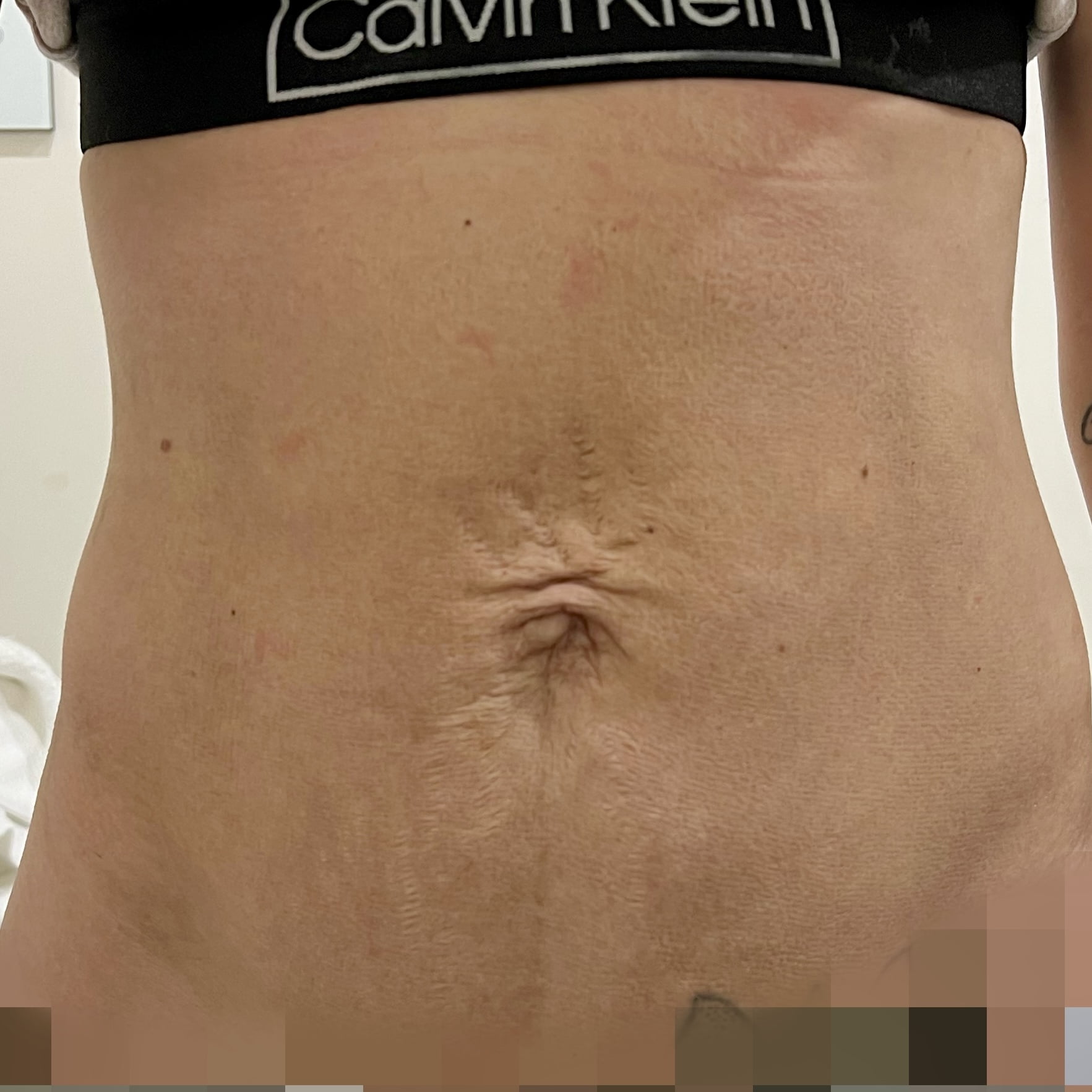 After Thermage FLX body tightening for stomach