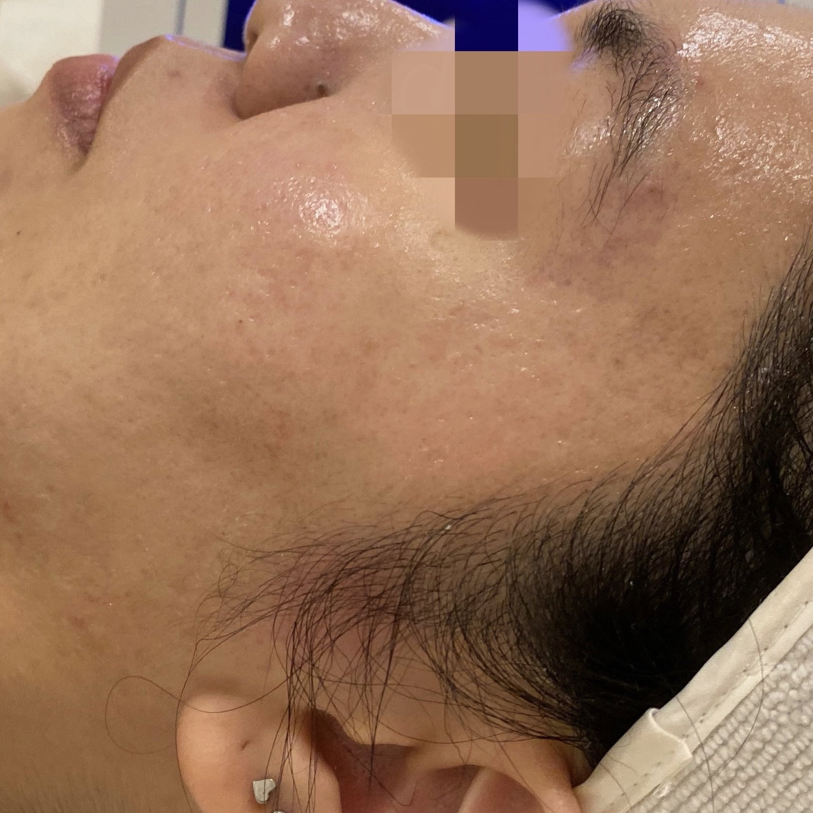 Client after 3 sessions of Venus Viva acne scar resurfacing.
