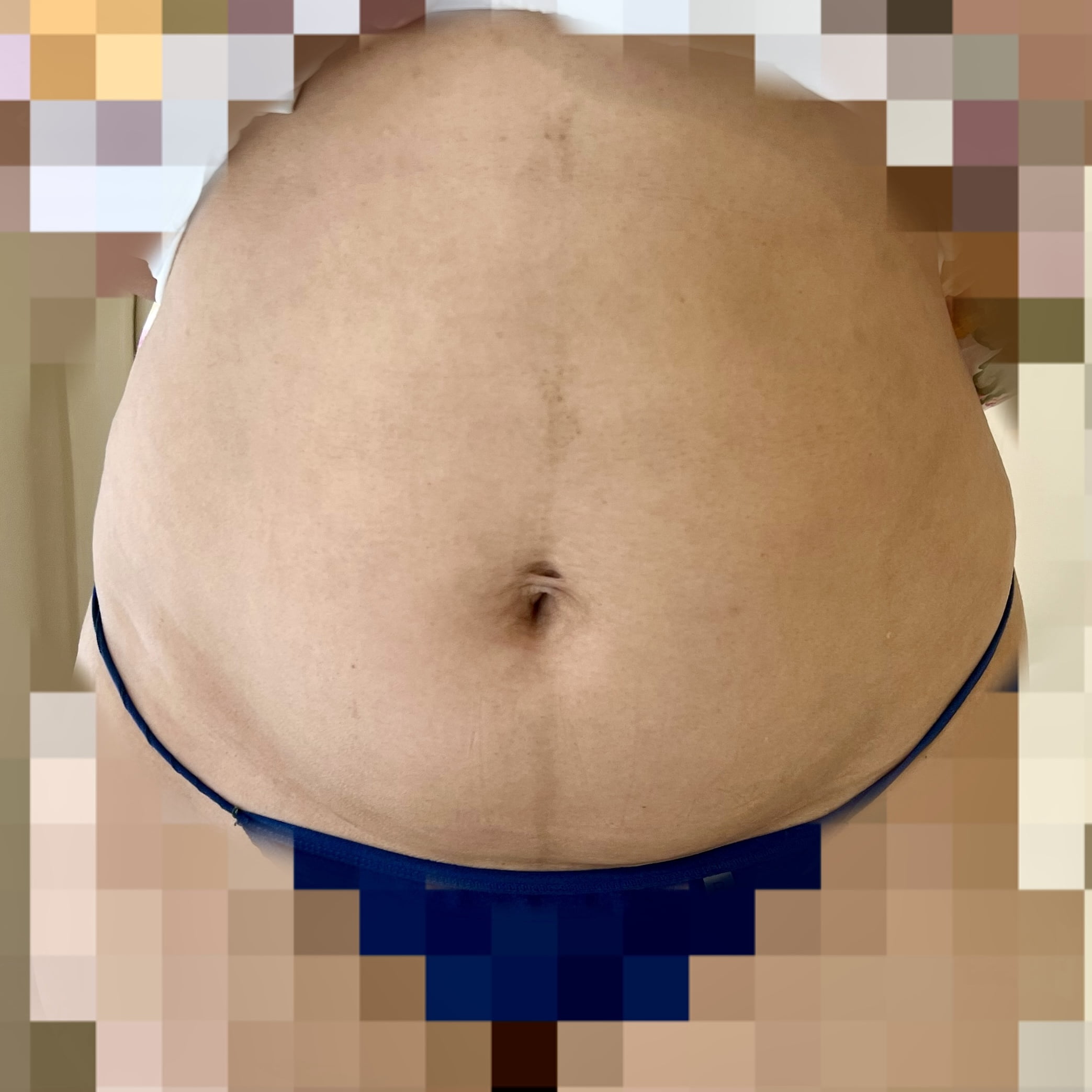 Client before Ultraformer III skin tightening for tummy