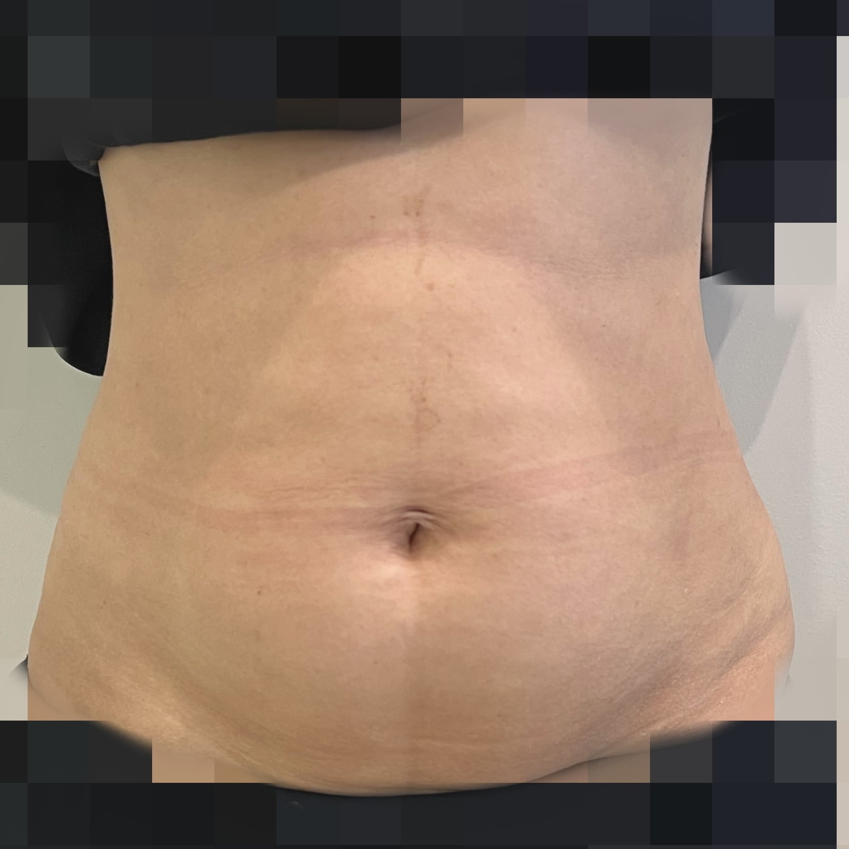 Client after 1 session of Ultraformer III skin tightening for tummy