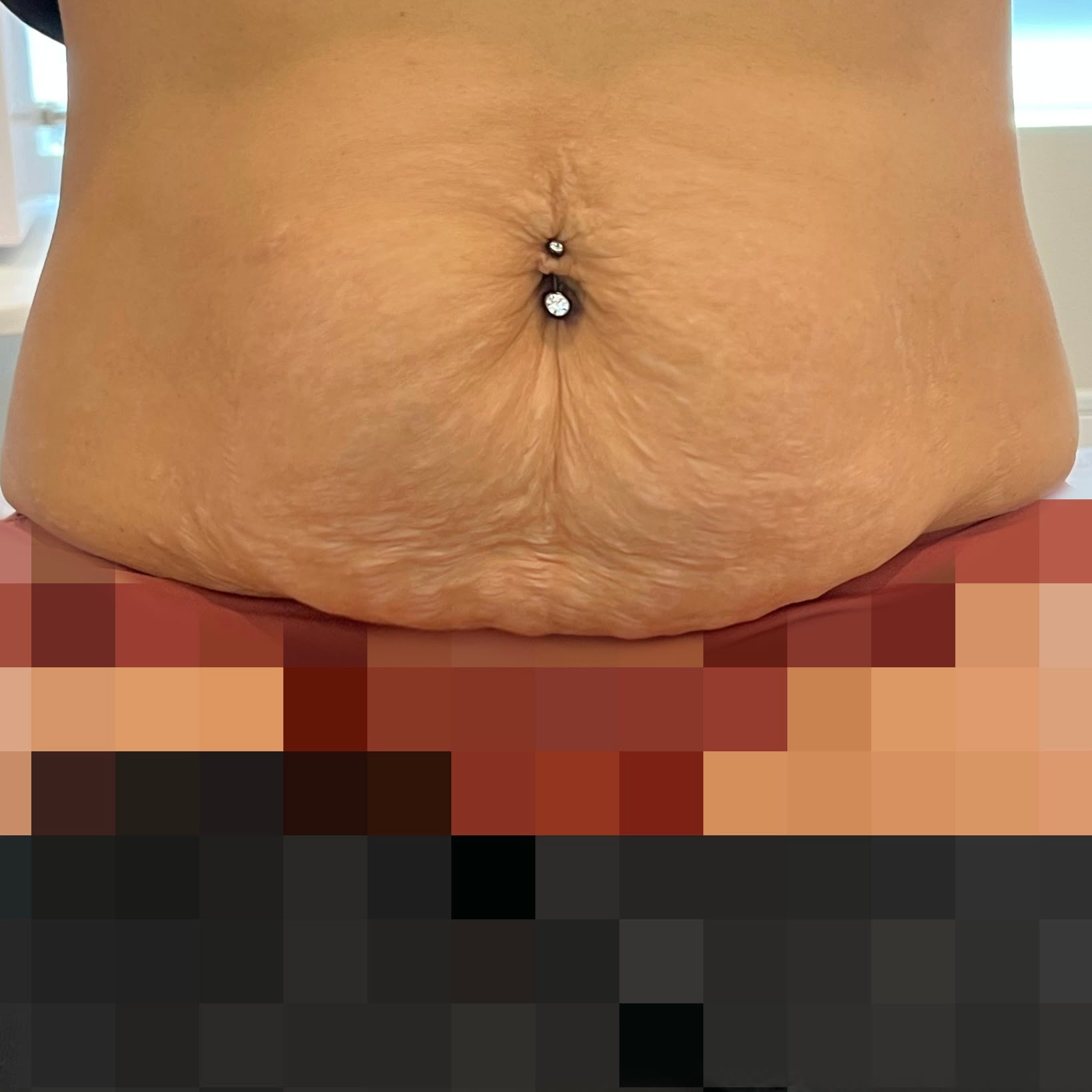 After Thermage FLX body tightening for stomach