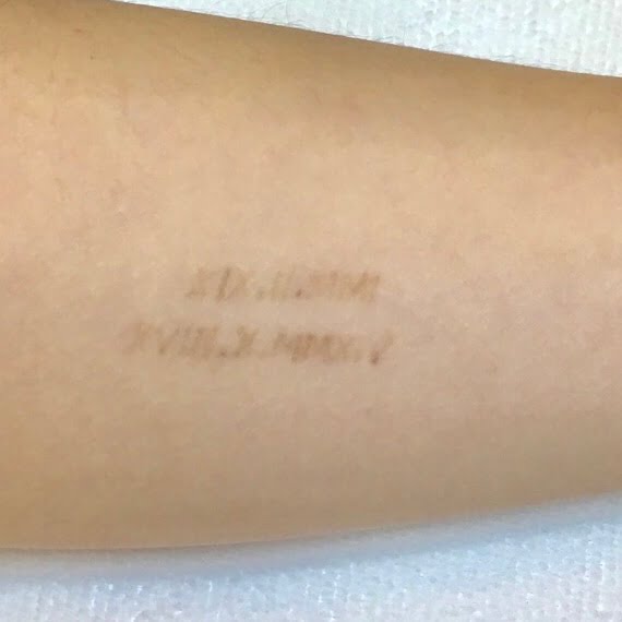 Client after 1 session of PiQo4 tattoo removal laser