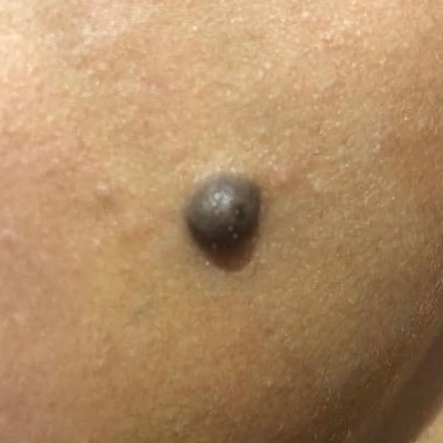 Client mole before mole removal treatment.