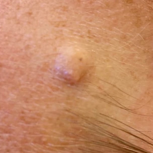 Client mole before wart removal treatment.